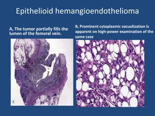 Epithelioid hemangioendothelioma
A, The tumor partially fills the
lumen of the femoral vein.
B, Prominent cytoplasmic vacuolization is
apparent on high-power examination of the
same case
 