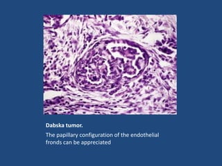 Dabska tumor.
The papillary configuration of the endothelial
fronds can be appreciated
 