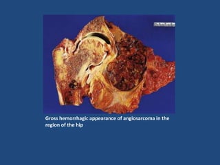 Gross hemorrhagic appearance of angiosarcoma in the
region of the hip
 