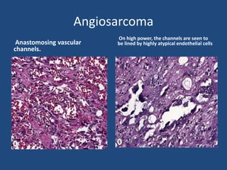 Angiosarcoma
Anastomosing vascular
channels.
On high power, the channels are seen to
be lined by highly atypical endothelial cells
 