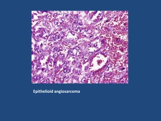Epithelioid angiosarcoma
 