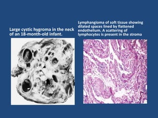 Large cystic hygroma in the neck
of an 18-month-old infant.
Lymphangioma of soft tissue showing
dilated spaces lined by flattened
endothelium. A scattering of
lymphocytes is present in the stroma
 
