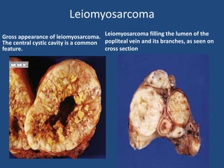 Leiomyosarcoma
Gross appearance of leiomyosarcoma.
The central cystic cavity is a common
feature.
Leiomyosarcoma filling the lumen of the
popliteal vein and its branches, as seen on
cross section
 