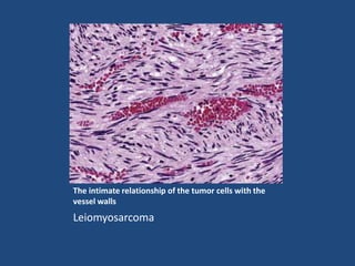 The intimate relationship of the tumor cells with the
vessel walls
Leiomyosarcoma
 