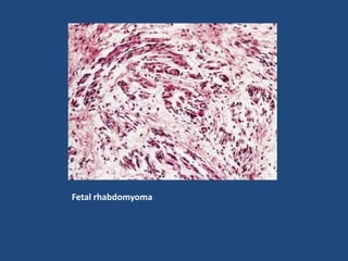 Fetal rhabdomyoma
 