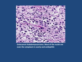 Embryonal rhabdomyosarcoma. Most of the nuclei are
oval; the cytoplasm is scanty and acidophilic
 