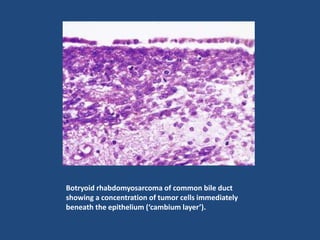 Botryoid rhabdomyosarcoma of common bile duct
showing a concentration of tumor cells immediately
beneath the epithelium (‘cambium layer’).
 