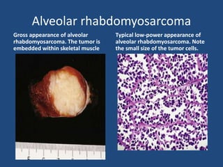 Alveolar rhabdomyosarcoma
Gross appearance of alveolar
rhabdomyosarcoma. The tumor is
embedded within skeletal muscle
Typical low-power appearance of
alveolar rhabdomyosarcoma. Note
the small size of the tumor cells.
 