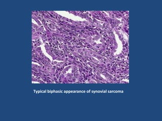 Typical biphasic appearance of synovial sarcoma
 