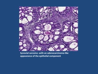 Synovial sarcoma -with an adenocarcinoma-like
appearance of the epithelial component
 