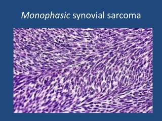 Monophasic synovial sarcoma
 