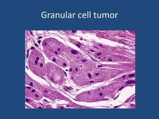 Granular cell tumor
 