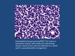Extraskeletal Ewing sarcoma/PNET. The tumor is
extremely cellular, with hardly any intervening
stroma. Some tumor cells are attached to a vessel
wall in a pseudorosette arrangement
 