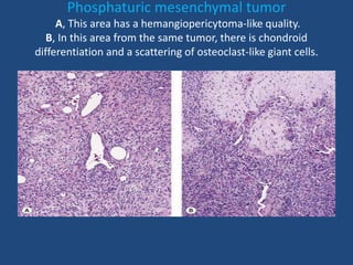 Phosphaturic mesenchymal tumor
A, This area has a hemangiopericytoma-like quality.
B, In this area from the same tumor, there is chondroid
differentiation and a scattering of osteoclast-like giant cells.
 