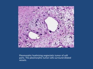 Pleomorphic hyalinizing angiectatic tumor of soft
parts. The pleomorphic tumor cells surround dilated
vessels.
 