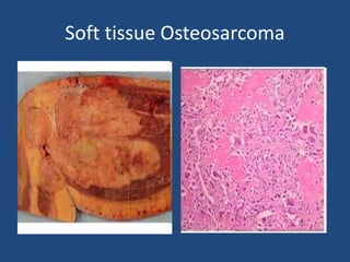 Soft tissue Osteosarcoma
 