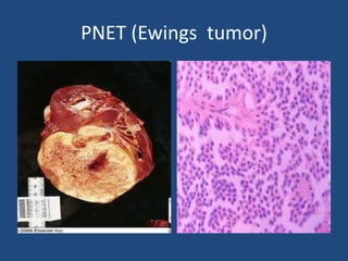 PNET (Ewings tumor)
 
