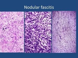 Nodular fascitis
 