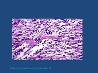 Collagen deposition in nodular fasciitis
 