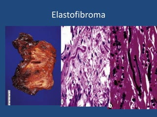 Elastofibroma
 