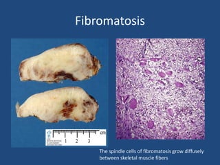 Fibromatosis
The spindle cells of fibromatosis grow diffusely
between skeletal muscle fibers
 