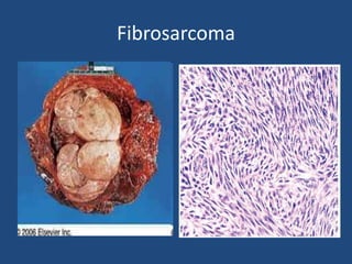 Fibrosarcoma
 