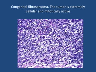 Congenital fibrosarcoma. The tumor is extremely
cellular and mitotically active
 
