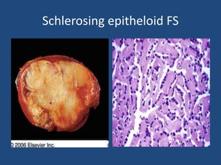 Schlerosing epitheloid FS
 
