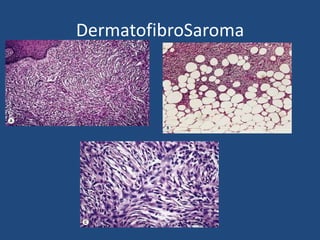 DermatofibroSaroma
 