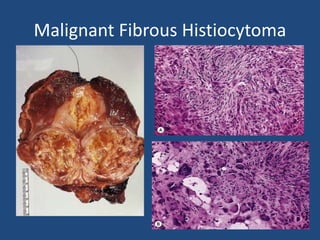 Malignant Fibrous Histiocytoma
 