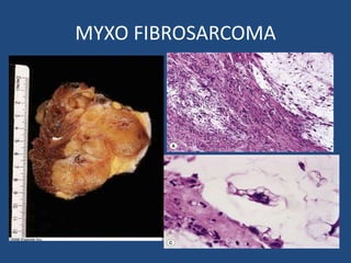 MYXO FIBROSARCOMA
 