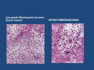 Low-grade fibromyxoid sarcoma
(Evans tumor) MYXO FIBROSARCOMA
 