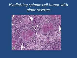 Hyalinizing spindle cell tumor with
giant rosettes
 