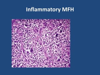Inflammatory MFH
 