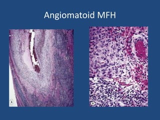 Angiomatoid MFH
 