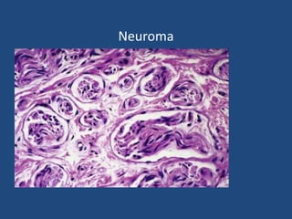 Neuroma
 