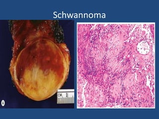 Schwannoma
 