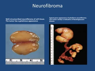 Neurofibroma
Well-circumscribed neurofibroma of soft tissue.
The tumor has a gelatinous appearance
Typical gross appearance of plexiform neurofibroma.
This tumor variety is indicative of Recklinghausen
disease
 