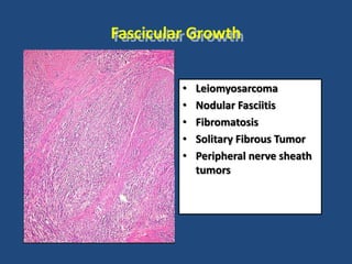Fascicular Growth
• Leiomyosarcoma
• Nodular Fasciitis
• Fibromatosis
• Solitary Fibrous Tumor
• Peripheral nerve sheath
tumors
 