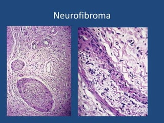 Neurofibroma
 