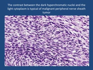 The contrast between the dark hyperchromatic nuclei and the
light cytoplasm is typical of malignant peripheral nerve sheath
tumor
 