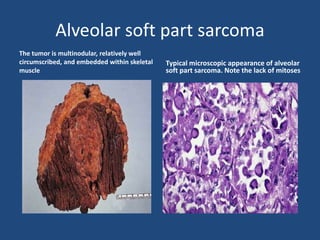 Pleomorphic hyalinizing angiectatic tumor of soft
parts. The pleomorphic tumor cells surround dilated
vessels.
 
