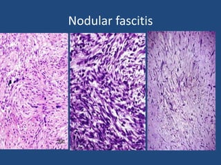 Collagen deposition in nodular fasciitis
 
