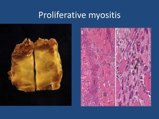 Myositis ossificans
• It is a reactive condition that is sometimes mistaken
microscopically for osteosarcoma.
• The term i...
