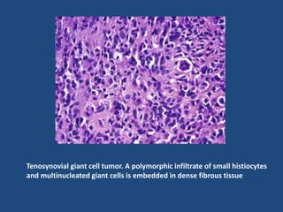 Intermediate (borderline) fibrous
histiocytoma
• This vaguely defined group of tumors is characterized by local
aggressive...