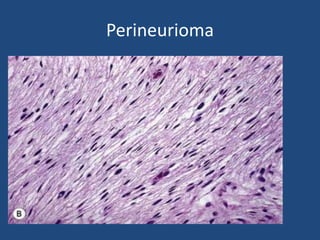 Malignant peripheral nerve sheath
tumor
• Because of its difficult microscopic recognition,
errors are often made.
• There...