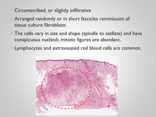 • Circumscribed, or slightly infiltrative
• Arranged randomly or in short fascicles reminiscent of
tissue culture fibroblasts
• The cells vary in size and shape (spindle to stellate) and have
conspicuous nucleoli; mitotic figures are abundant.
• Lymphocytes and extravasated red blood cells are common.
 