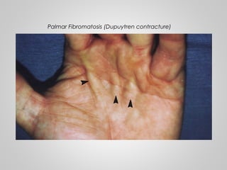 Palmar Fibromatosis (Dupuytren contracture)
 