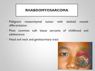 RHABDOMYOSARCOMA
• Malignant mesenchymal tumor with skeletal muscle
differentiation
• Most common soft tissue sarcoma of childhood and
adolescence
• Head and neck and genitourinary tract
 