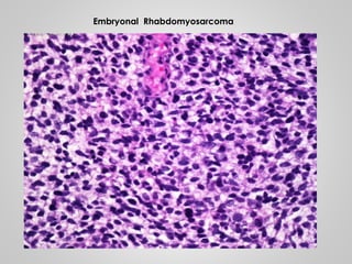 Embryonal Rhabdomyosarcoma
 